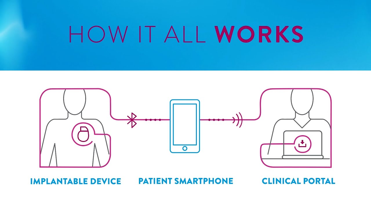 The Benefits of a Bluetooth-Enabled Pacemaker with Raffaele Corbisiero, MD