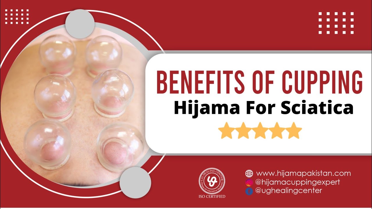 Hijama For Sciatica - Instant Back Pain Relief - Cupping Therapy