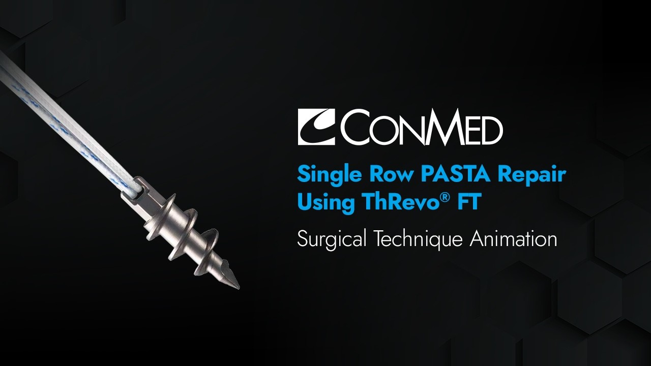 Single Row PASTA Repair Using ThRevo® FT - CONMED Animation