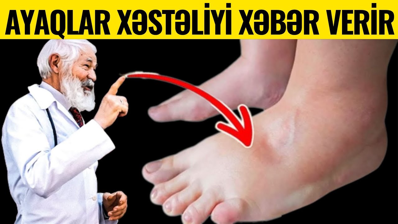 Ayaq Şişməsinin 8 VACİB SƏBƏBİ