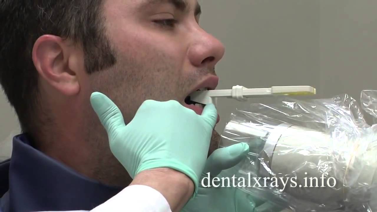 Tips Taking Dental X-Rays When Patient Has Tori | Dentsply Sirona
