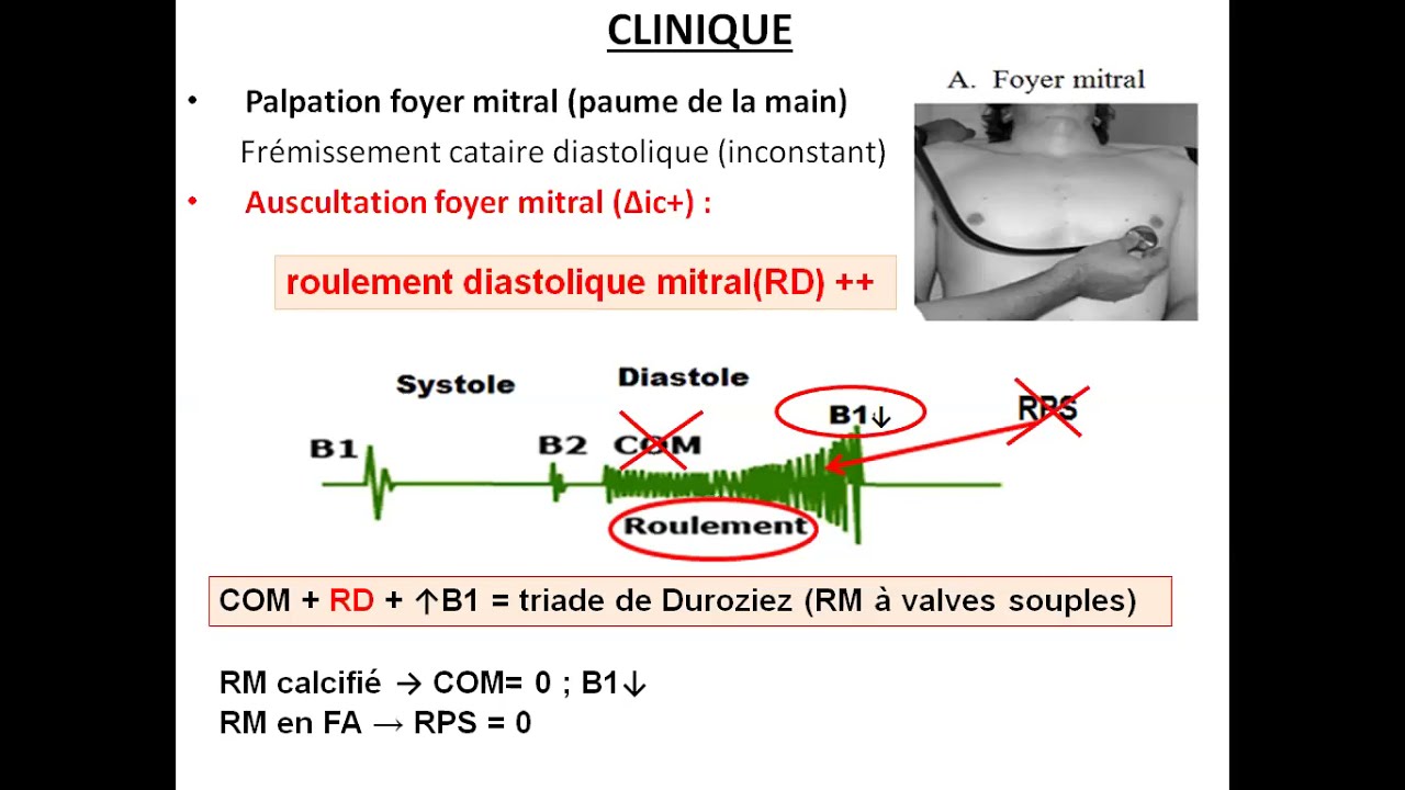 02. Rétrécissement mitral (Pr Daimellah) | #Cardio