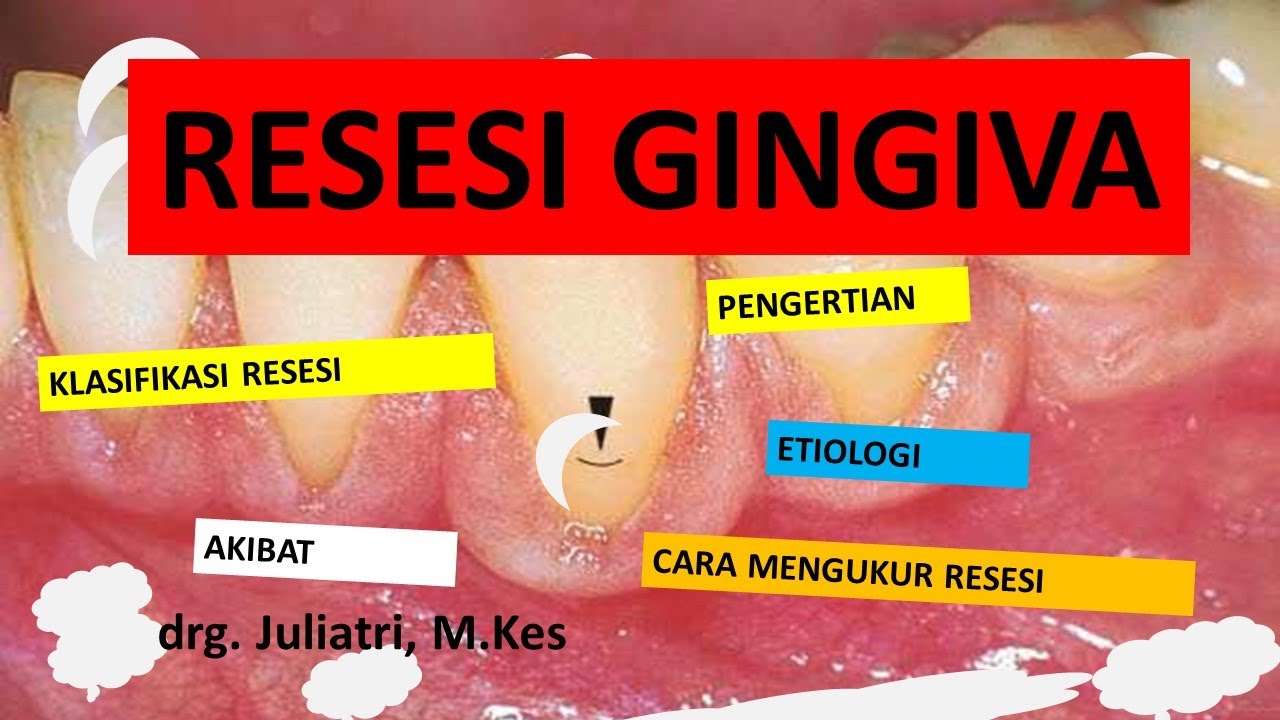 Pemeriksaan, Klasifikasi Resesi Gingiva | Dokter Gigi Channel