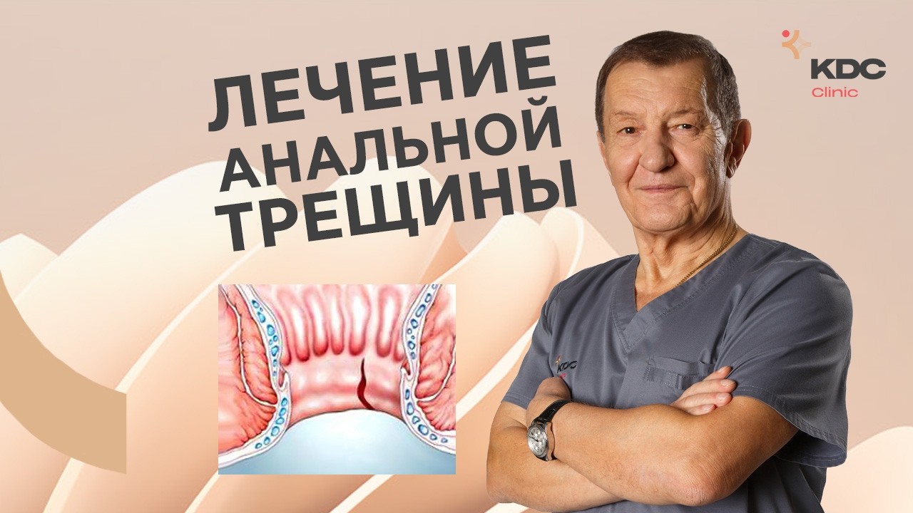 Современное лечение анальной трещины. Методики снятия спазма анального сфинктера.