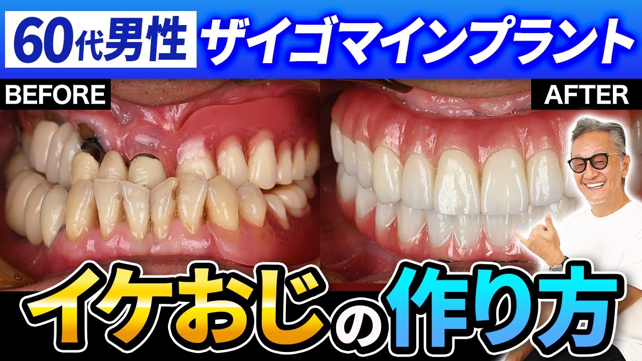 【症例解説シリーズ】60代男性のオールオン４ 部分入れ歯もブリッジもダメ。