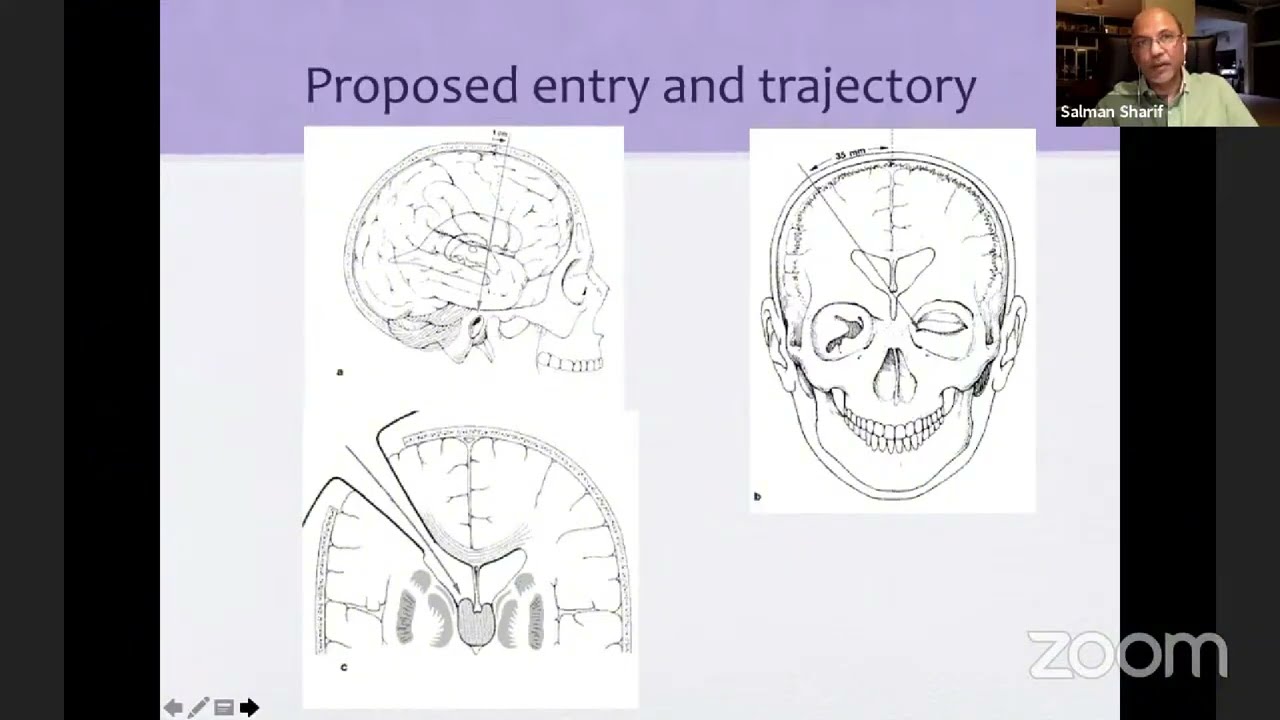 Dr. Salman Sharif - Anatomy and Complication Avoidance in ETV