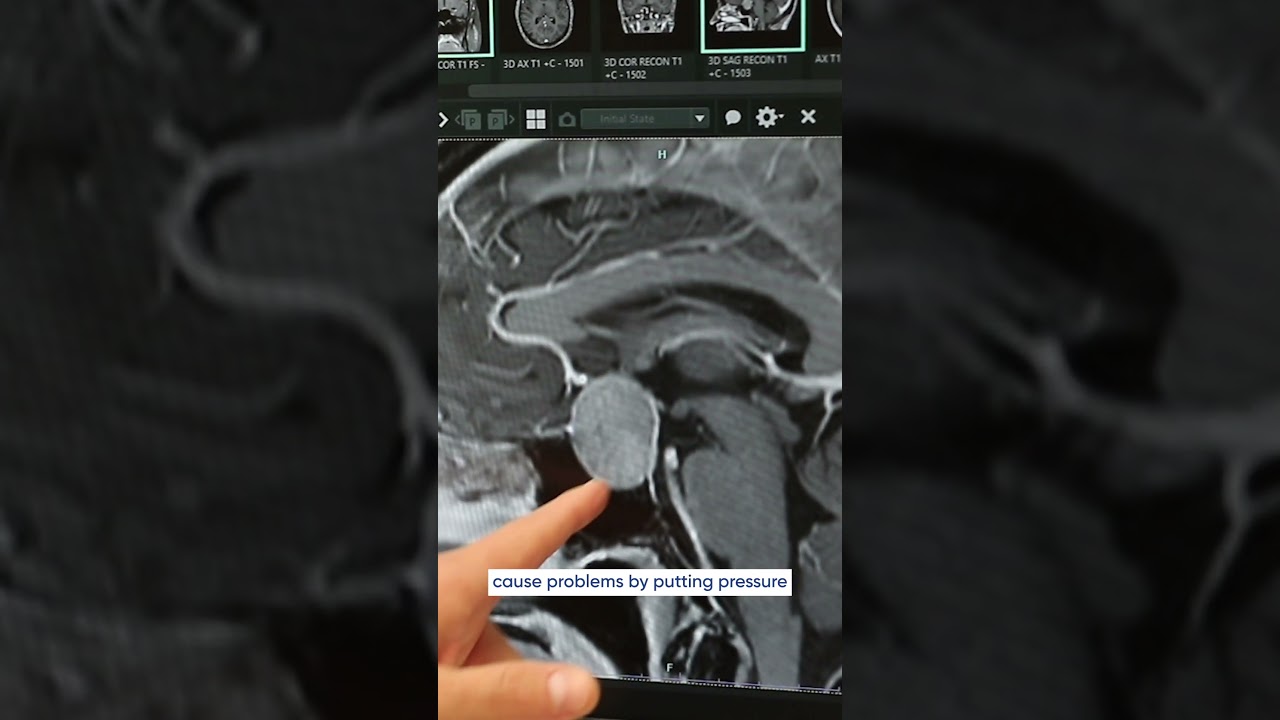 Signs of a Pituitary Tumor: What to Watch For #shorts