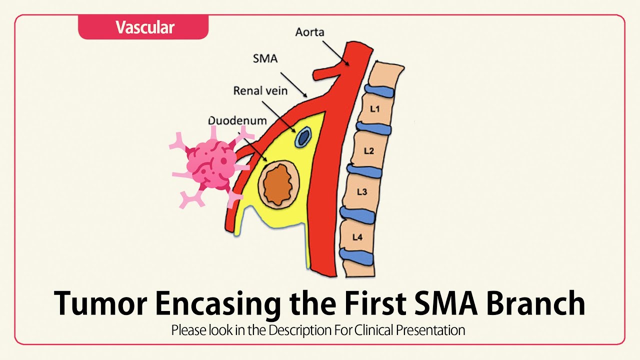 Tumor Encasing the First SMA Branch