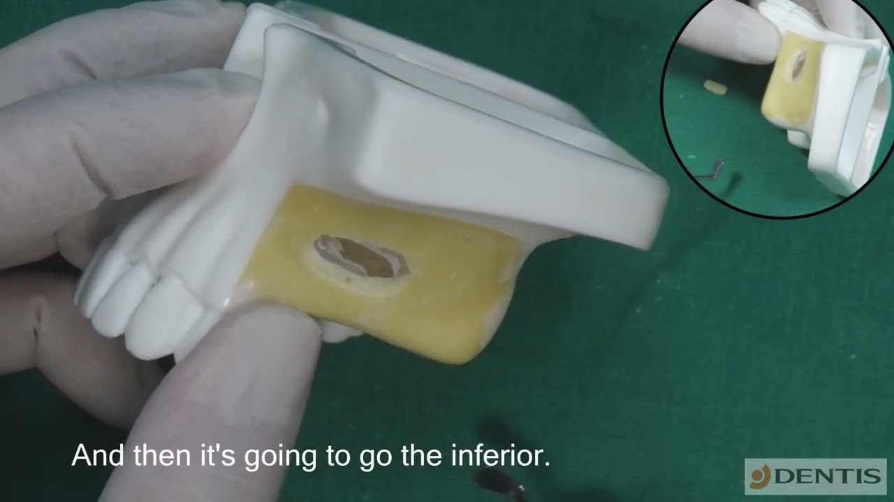Sinus Graft Demo