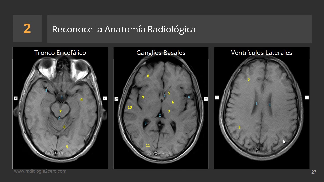 Cómo describir una RM de Cerebro