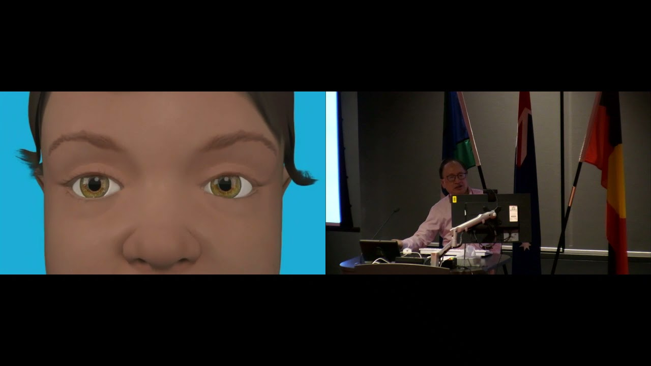 Ocular Manifestations in Noonan Syndrome - A/Prof Geoffrey Lam at the 2021 Noonan Syndrome Perth, WA