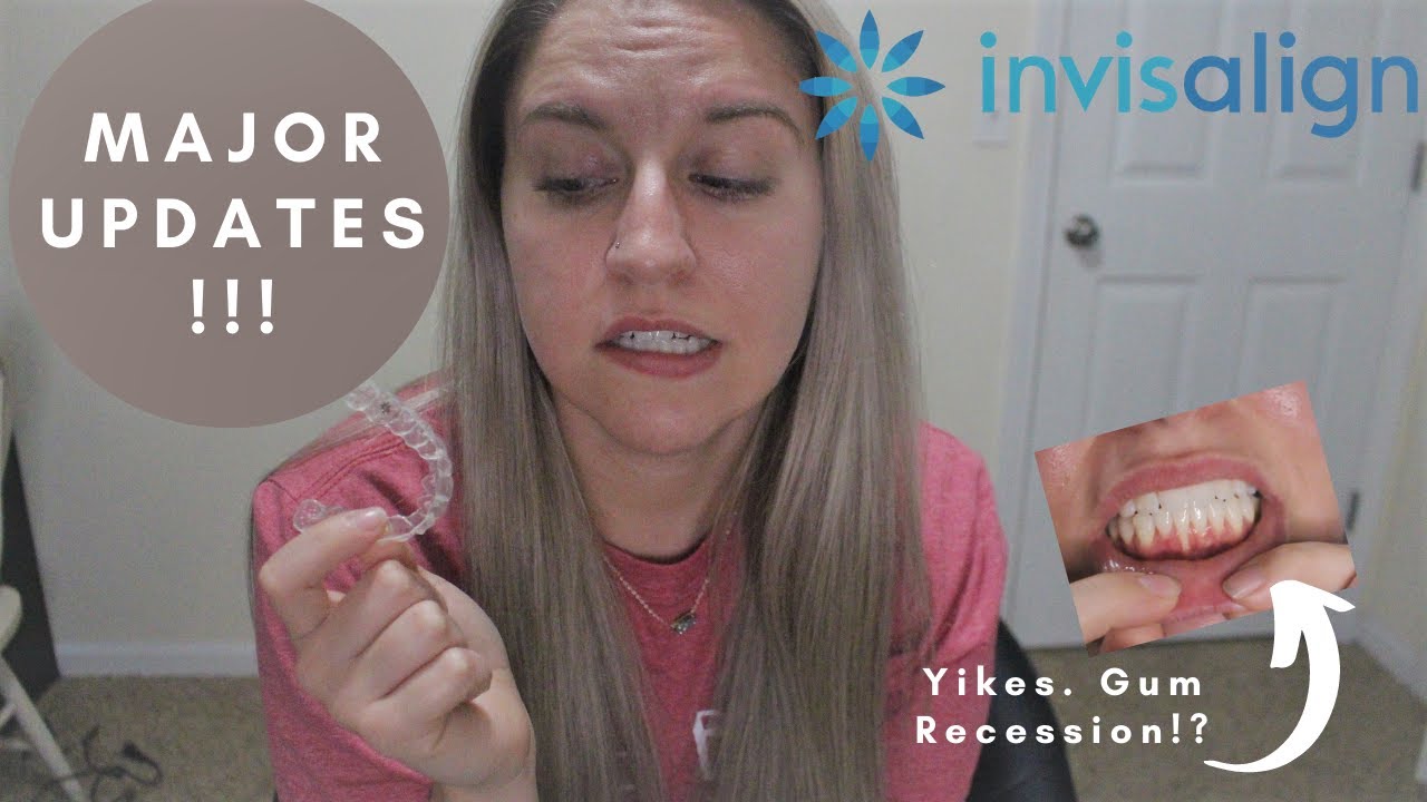 INVISALIGN UPDATE! Starting All Over, Refinements, Gum Recession!?