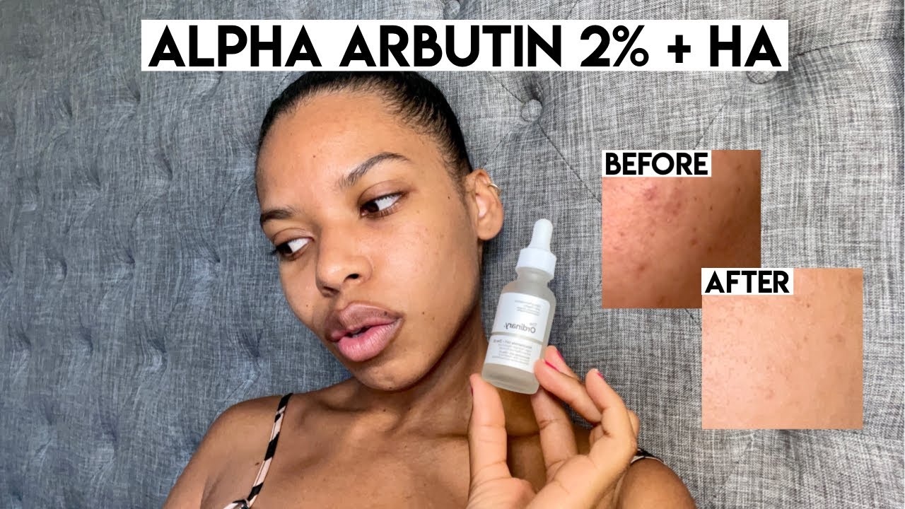 Обзор средства The Ordinary's Alpha Arbutin 2% + HA | Быстрое избавление от темных пятен!