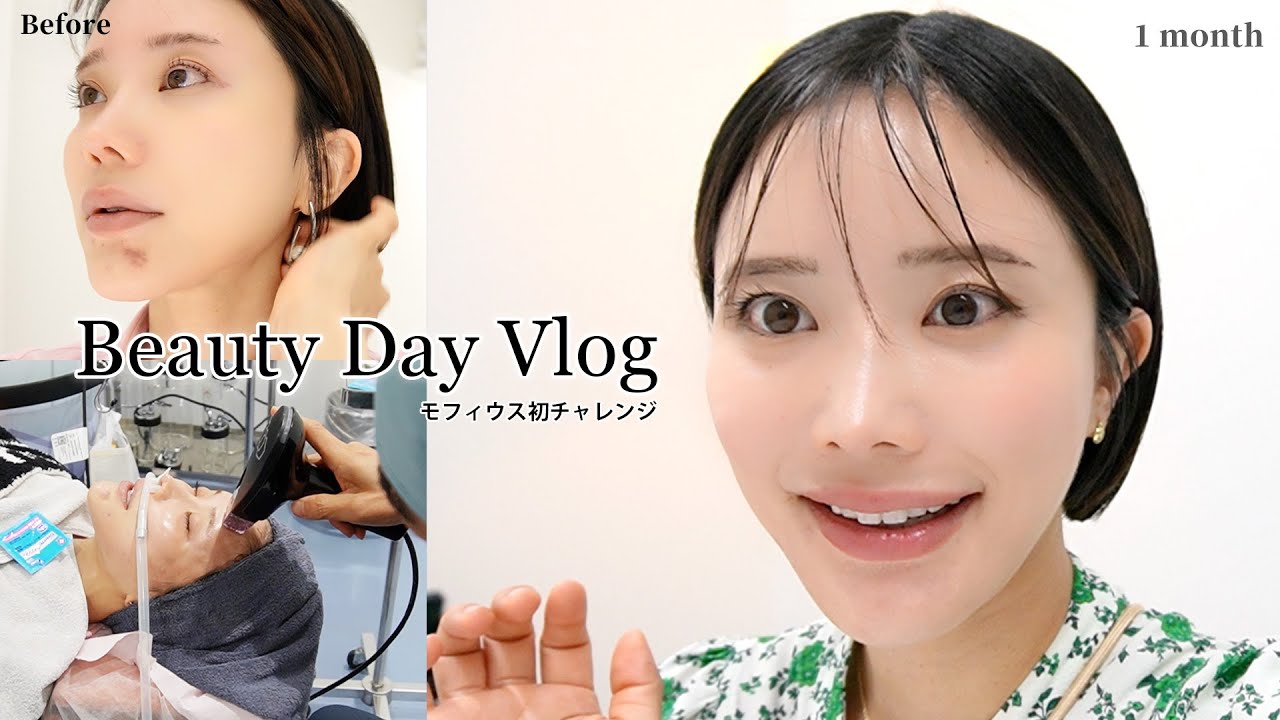 【vlog】話題のモフィウスを施術直後〜1ヶ月後までレポ🧖🏻‍♀️💉💬 【美容医療・ダウンタイム】