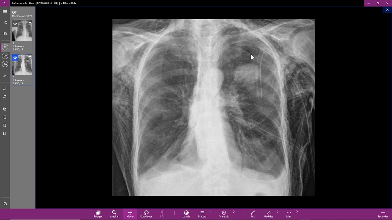 Enfisema subcutâneo