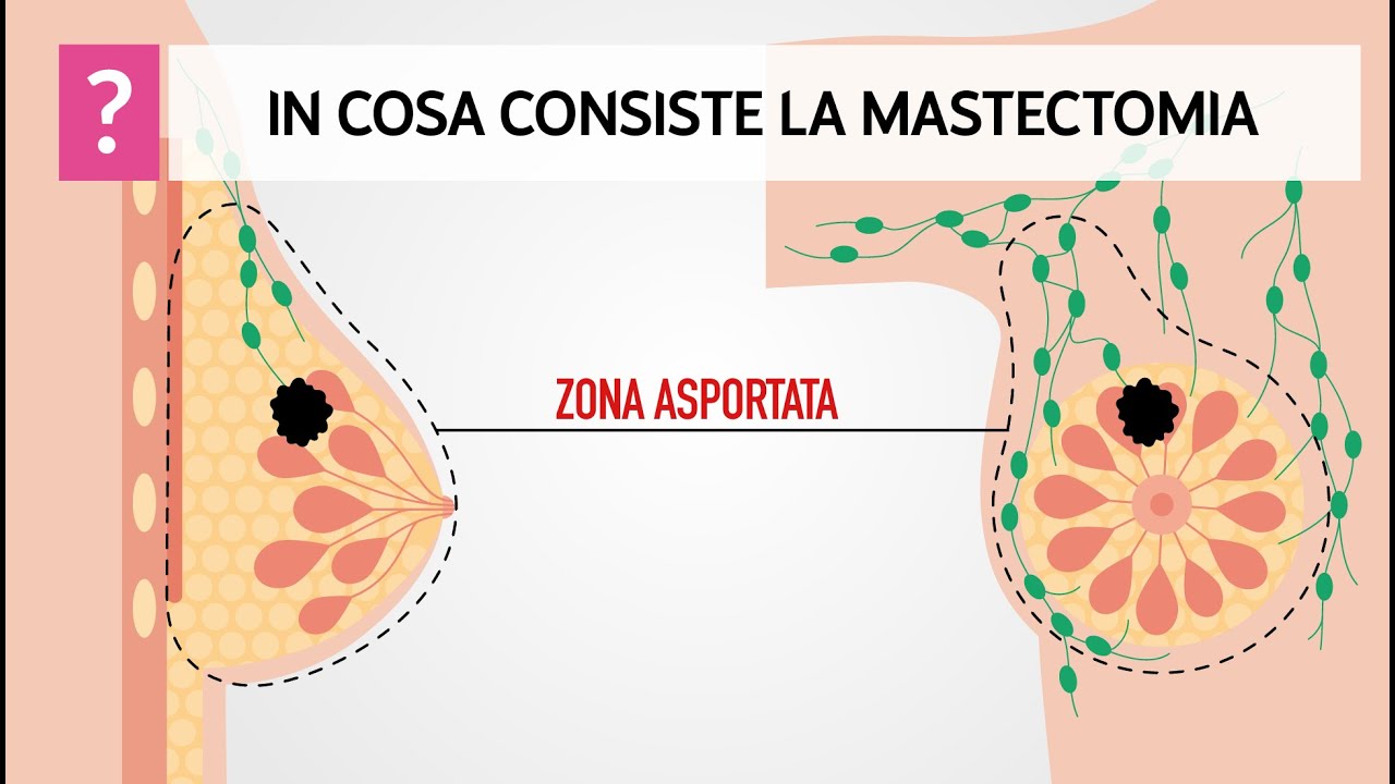 Mastectomia, in cosa consiste