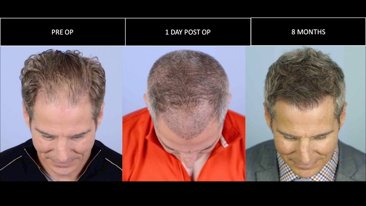 Matt FINALLY Gets an FUE Hair Transplant!!!!