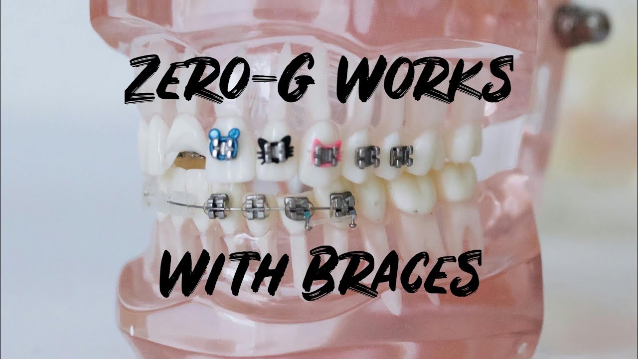 Zero-G Works With Braces