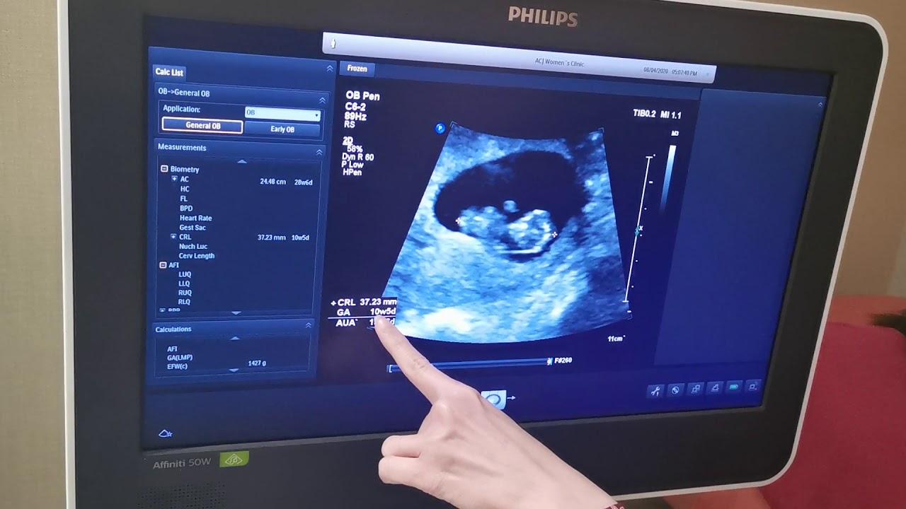 10 Weeks Pregnant Ultrasound. Baby is moving. Baby doing Kung-fu!!!