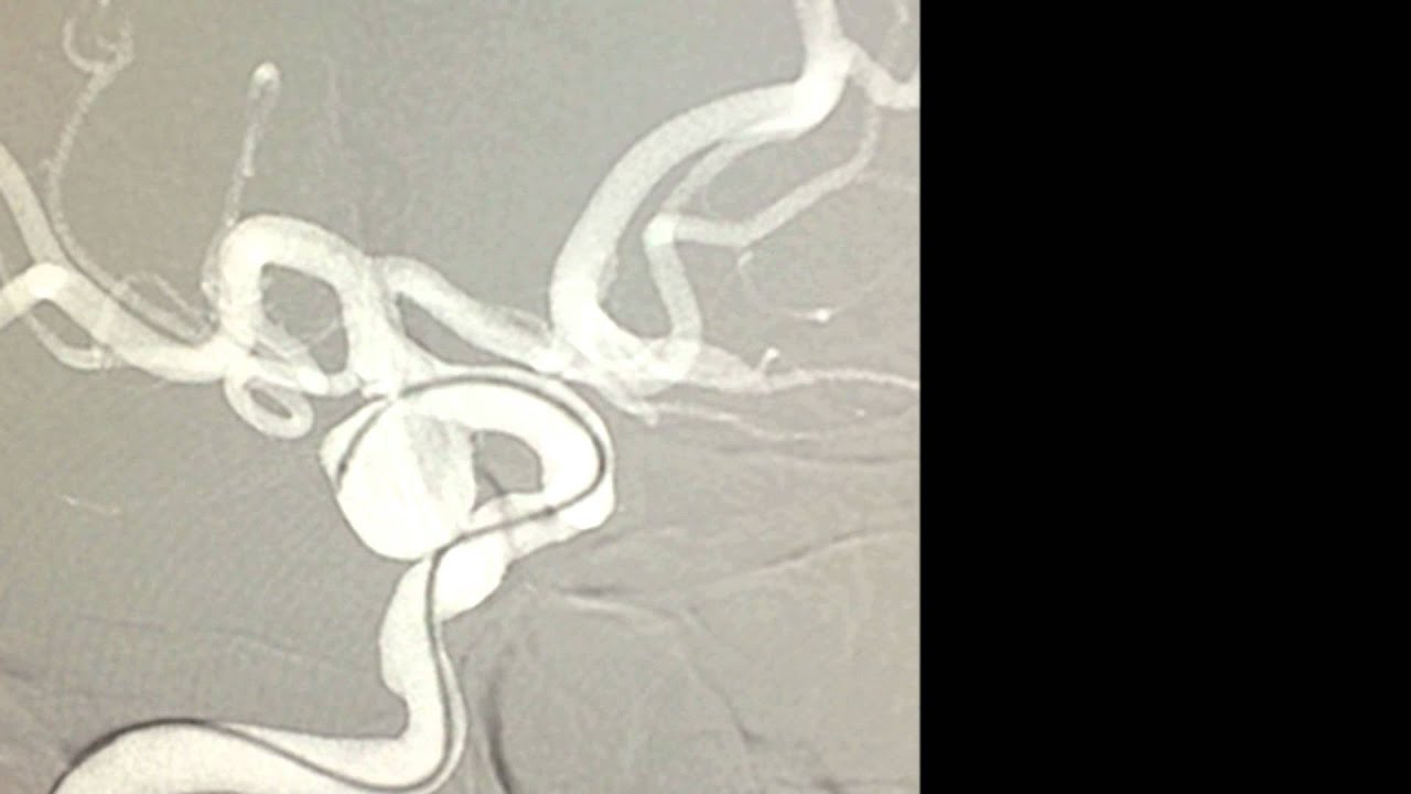 Endovascular coil embolization of unruptured posterior communicating artery aneurysm