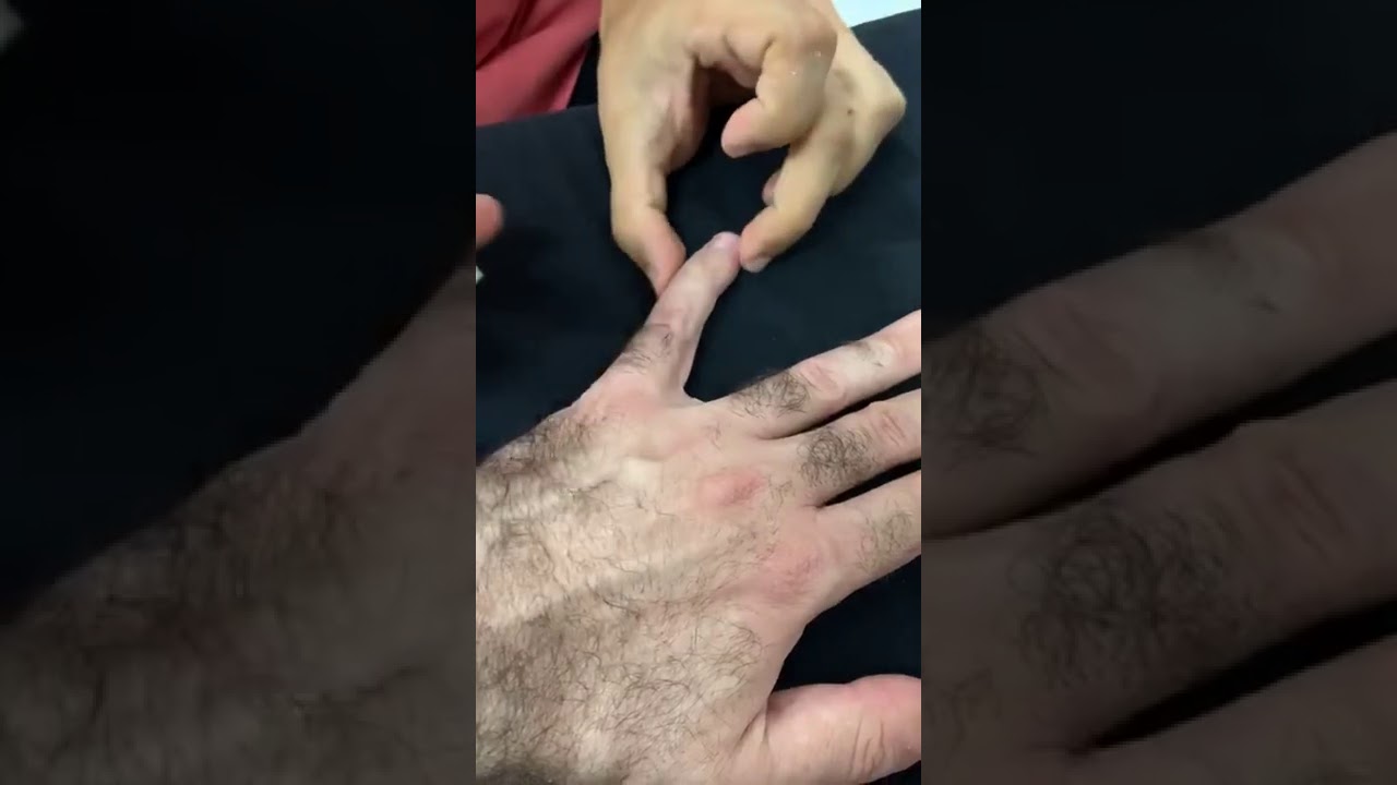 BANDAGEM RÍGIDA DOR INTERFALANGIANA ARTROSE DEDOS MÃO Clínica de Fisioterapia Dr. Robson Sitta