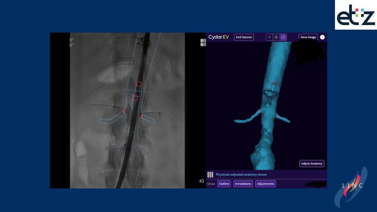 Improve endovascular performance: Comparing Cydar EV with Vessel Navigator from Philips.