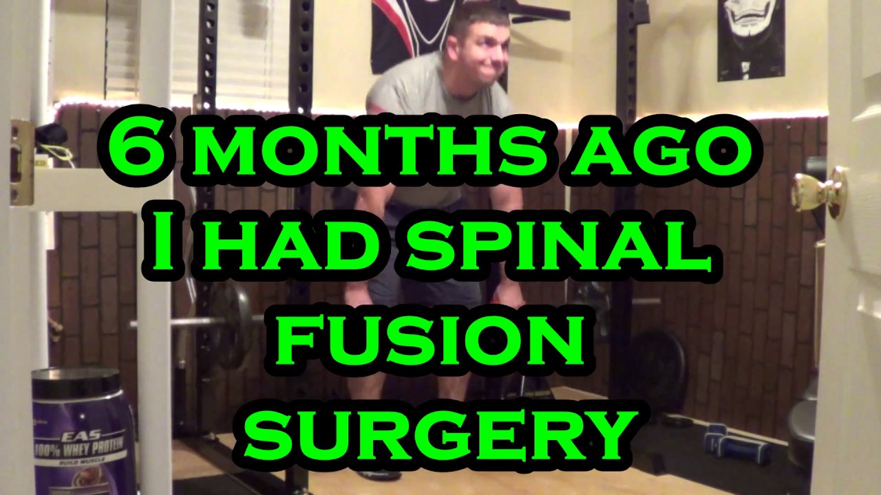 powerlifting 6 months after spinal fusion (L5-S1)