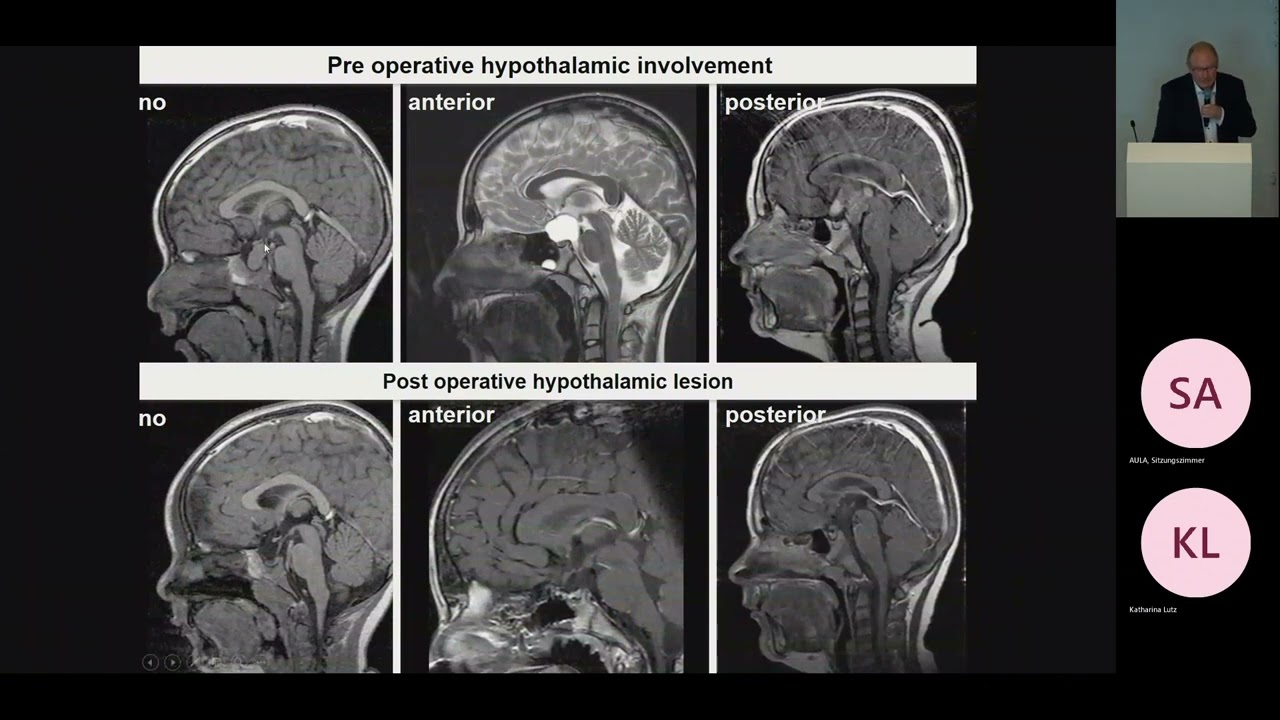 Pediatric Craniopharyngioma Pt.1, Craniopharyngioma - Overview and Classification