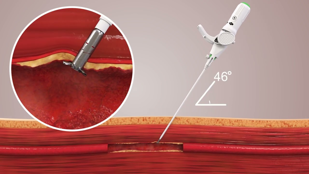 Celt ACD - Vascular Closure Device / Vasorum Ltd