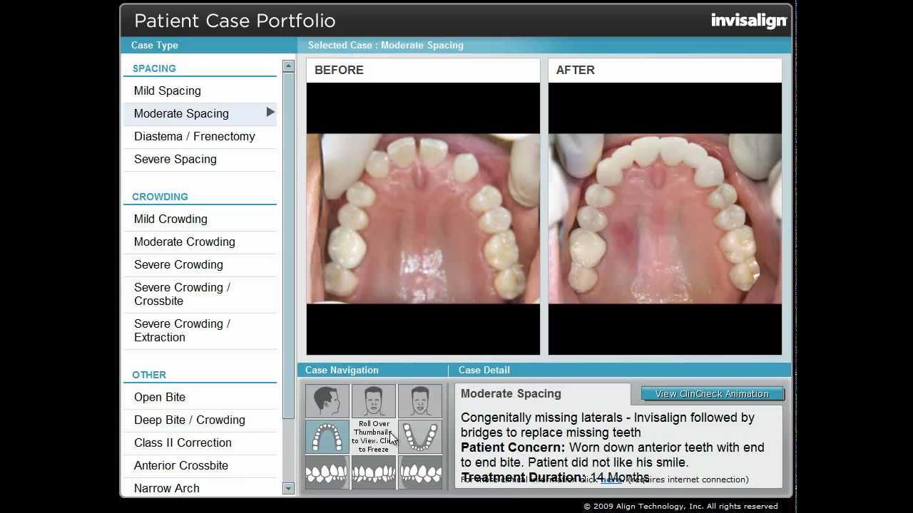 Invisalign Moderate Spacing