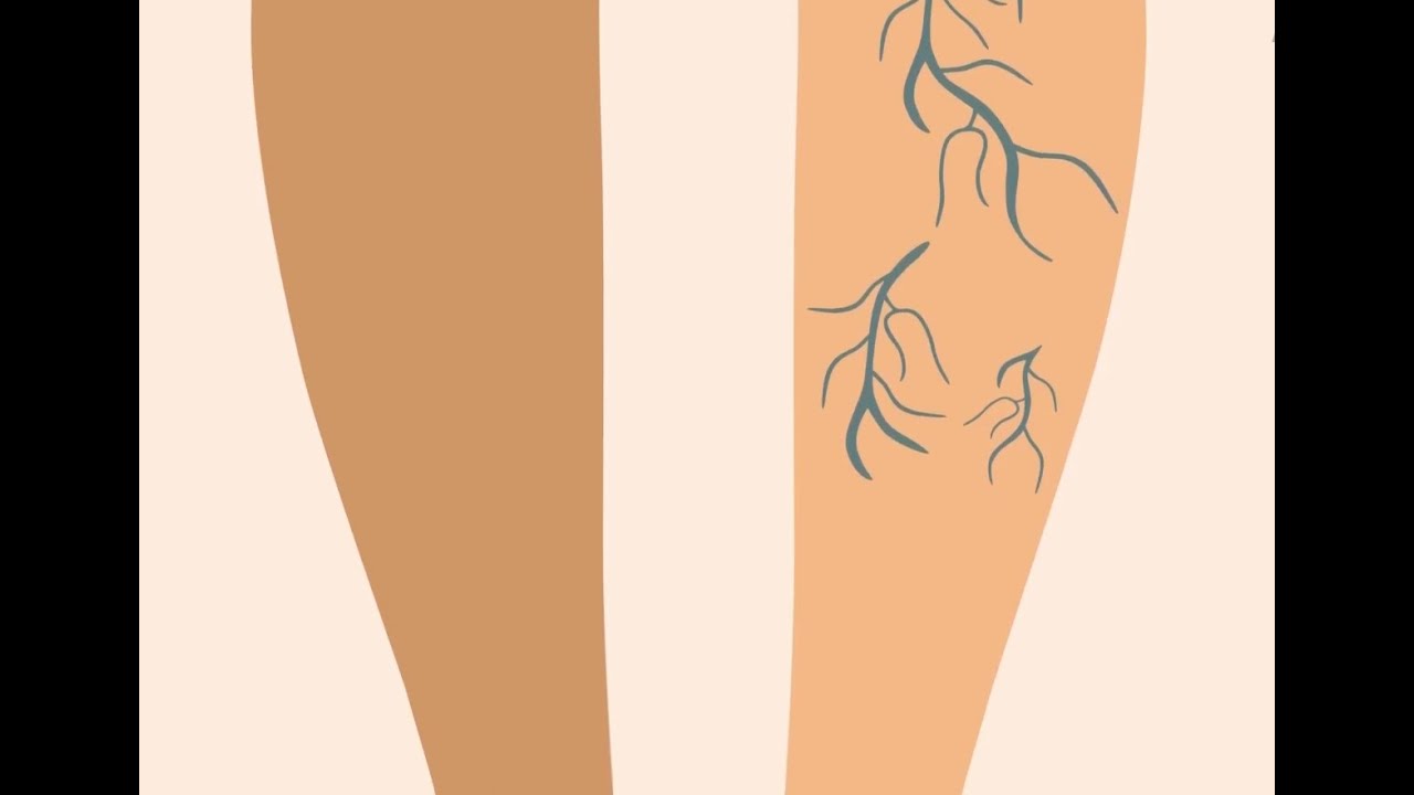 Le traitement mini-invasif des varices par laser