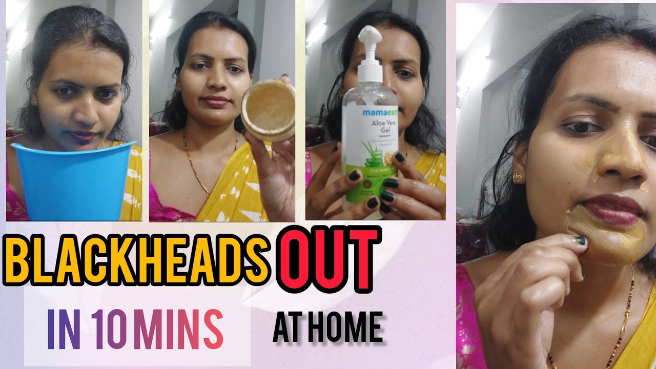 Whiteheads & Blackheads Remove at Home | व्हाइट हेड्स ब्लैक हेड्स हटाने का सही तरीका #noseblackhead
