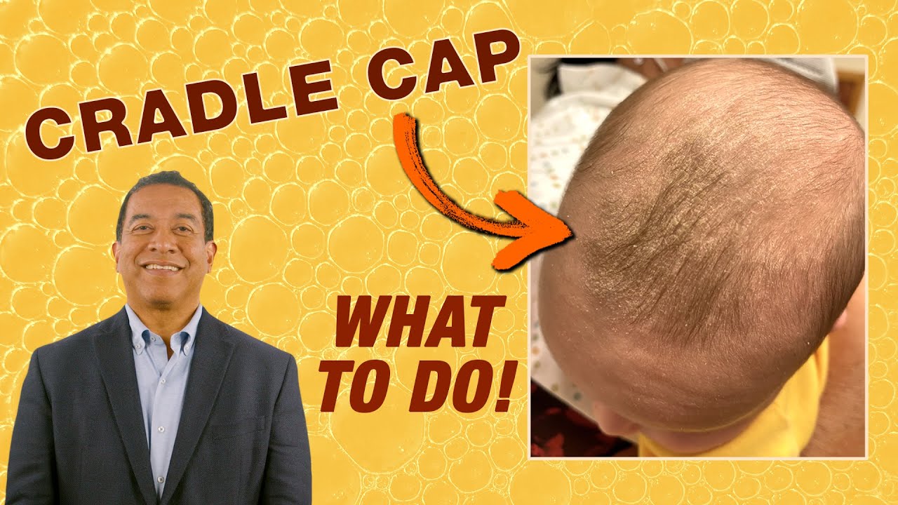 Cradle Cap: Pediatrician’s Tips for Parents (Seborrheic Dermatitis) | AAP