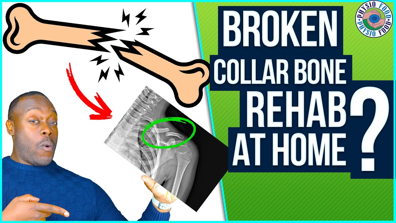How to Rehab a Fractured Collar Bone?