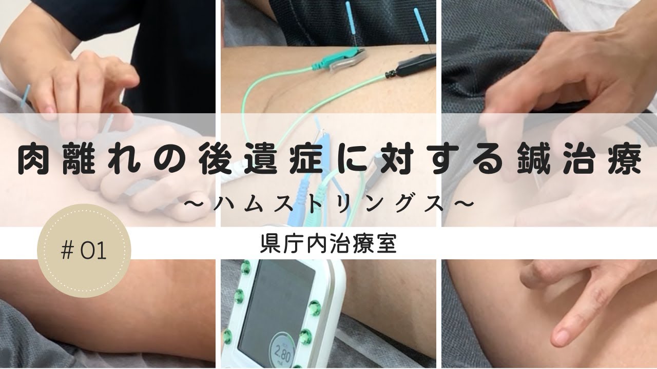 肉離れの後遺症に対する鍼治療　‐ハムストリングス‐