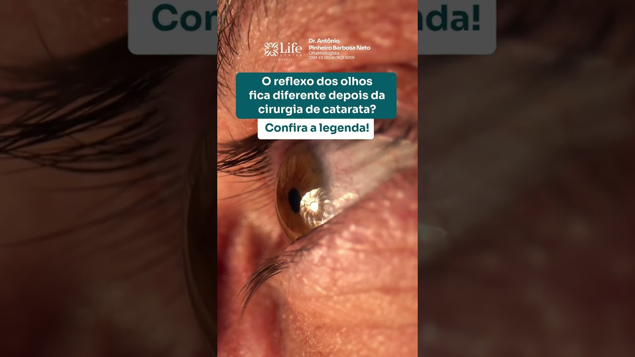 O REFLEXO DOS OLHOS AP&Oacute;S A CIRURGIA DE CATARATA? |Dr. Ant&ocirc;nio Pinheiro Barbosa Neto
