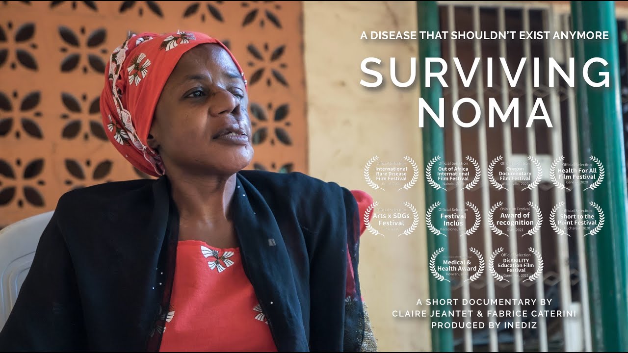 Surviving noma - Official Selection - Health for All Film Festival