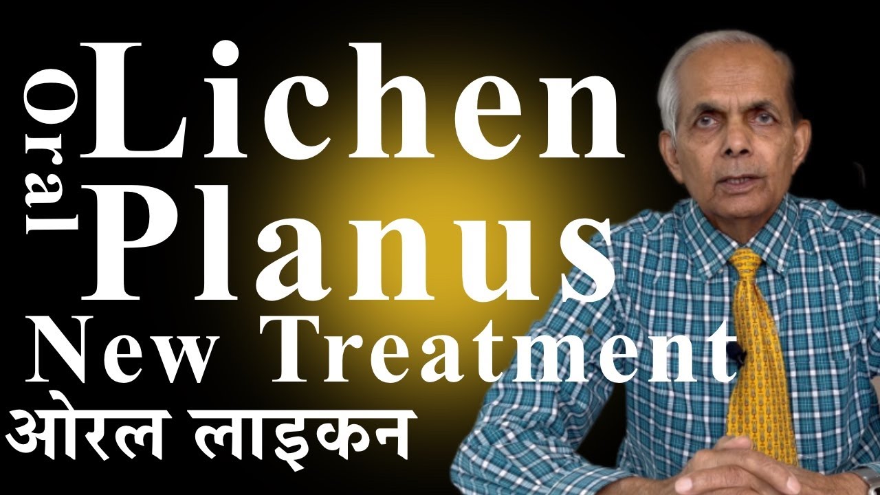 Oral Lichen planus, New Treatment and Home Remedies/ मुँह का लाइकन प्लेनस, नया और घरेलू इलाज