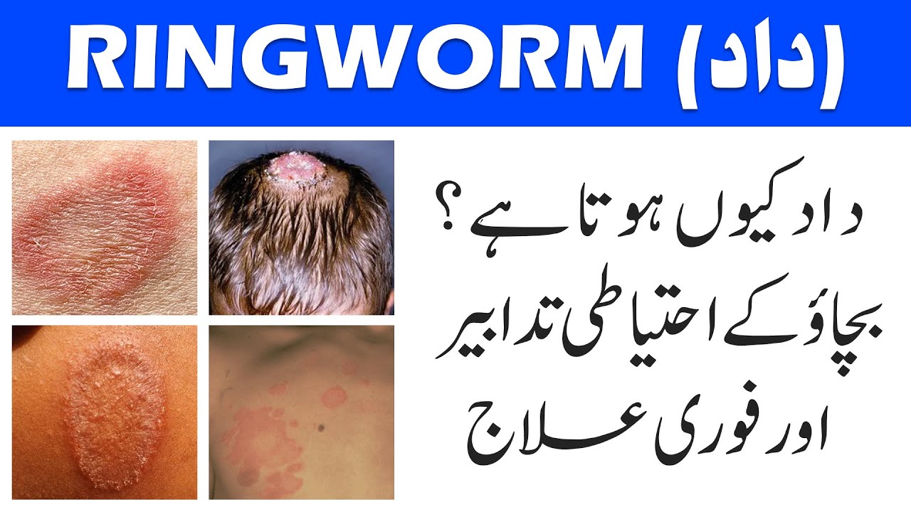 Ringworm (Daad) Ka Ilaj | Fungal Infection Treatment in Urdu/Hindi | Home Remedies & Medicine