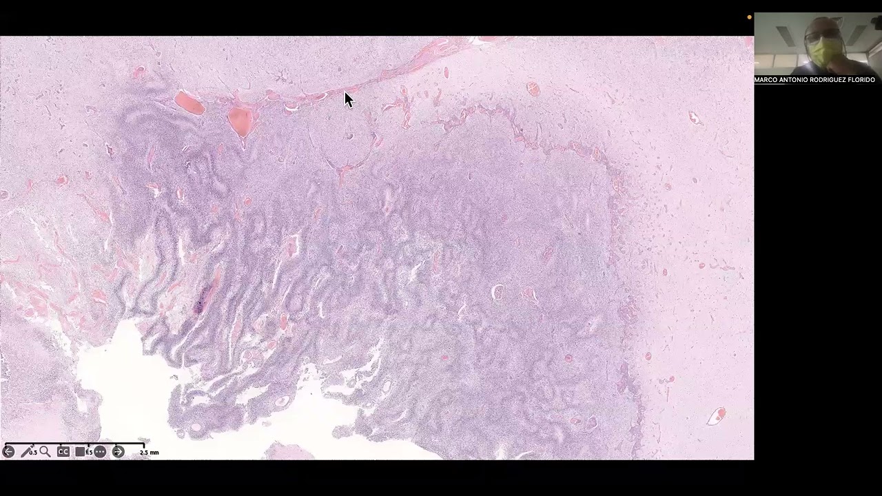 Glioblastoma CASO CLÍNICO