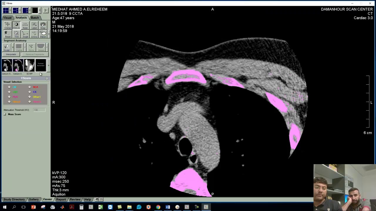 CA SCORE ESTIMATION UPON VITREA 6