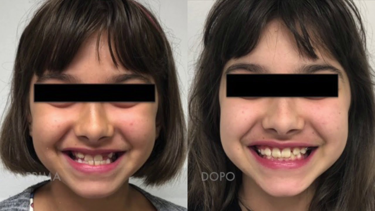 Trattamento di un Grave Morso Inverso Anteriore (Maleocclusione di Terza Classe)