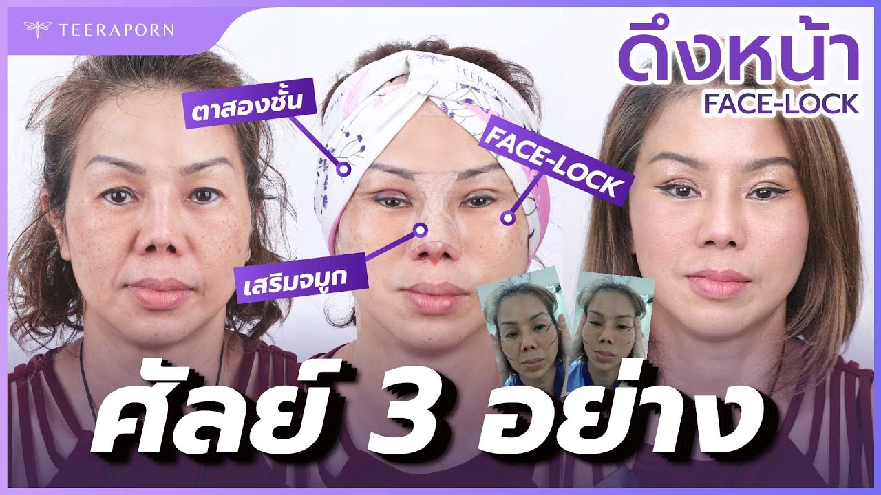 ศัลยกรรมทีเดียวเลย 3 อย่าง ดึงหน้าFACE-LOCK ทำตาสองชั้น เสริมจมูก(งานแก้) ธีรพรคลินิก หมอชลธิศ