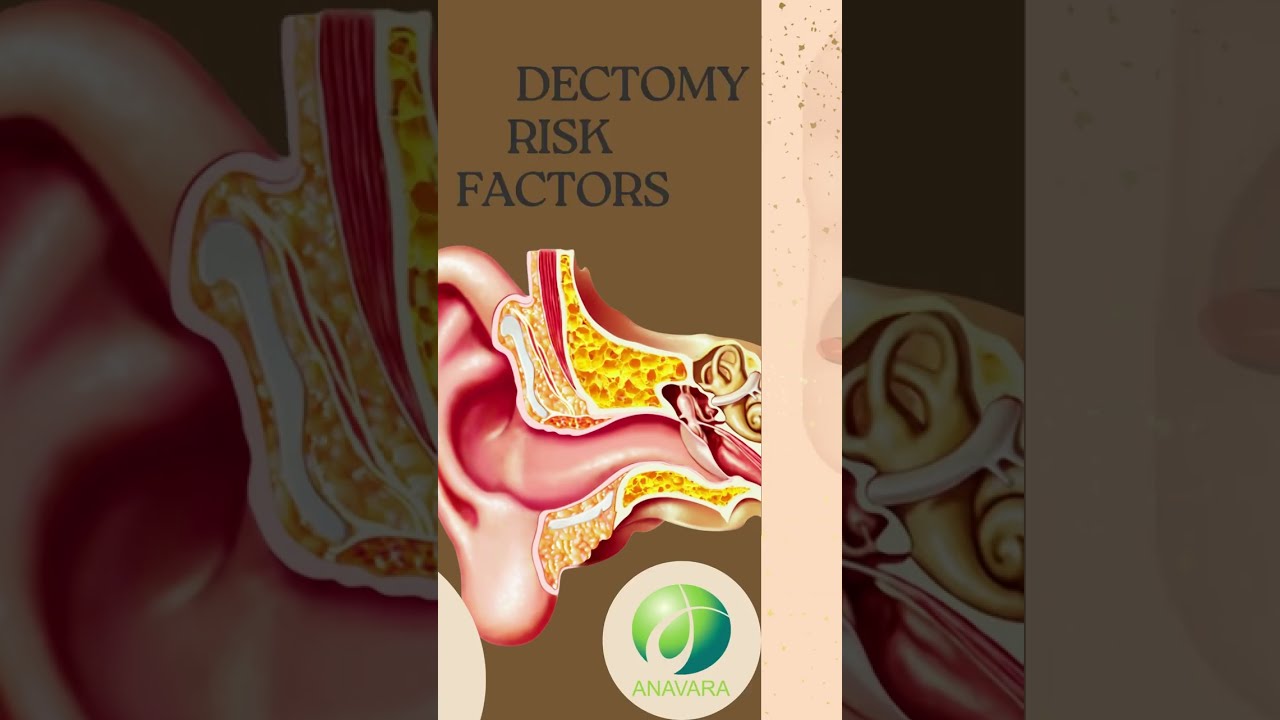 Stapedectomy Risk Factors #shorts #anavara #vkare