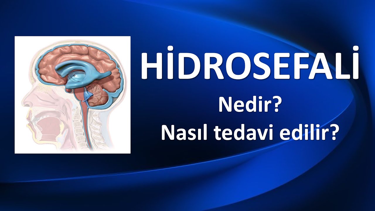 HİDROSEFALİ NEDİR? NASIL TEDAVİ EDİLİR?