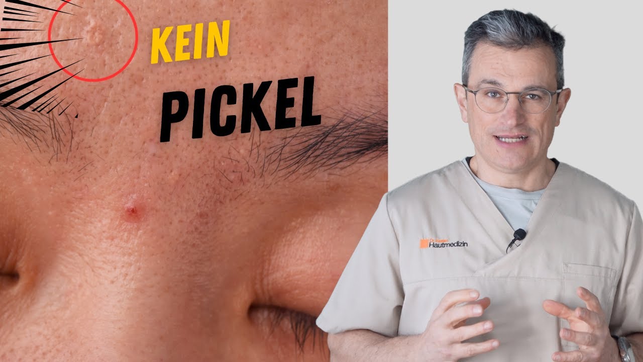 Talgdrüsenhyperplasie erkennen und entfernen. Dr. Kasten Hautarzt in Mainz