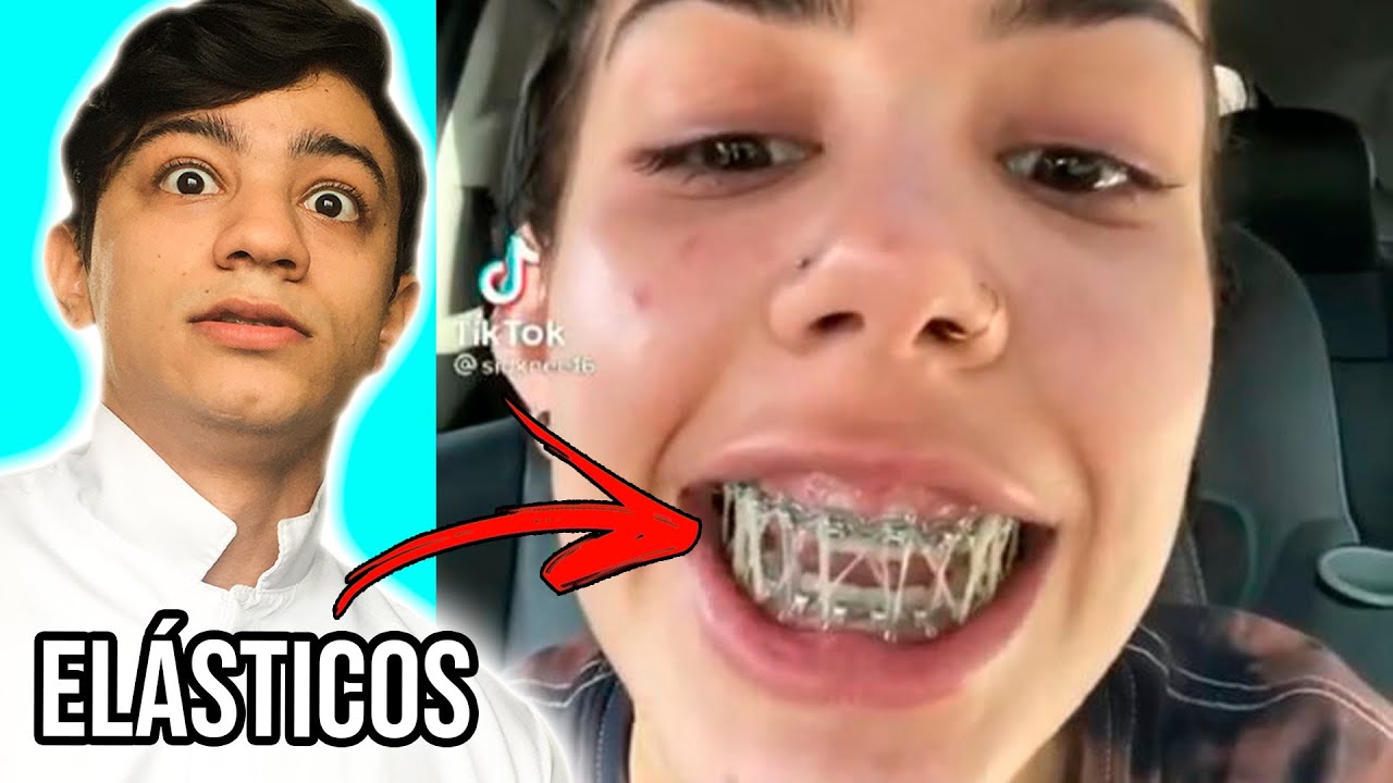 ELÁSTICOS no APARELHO. Entenda !