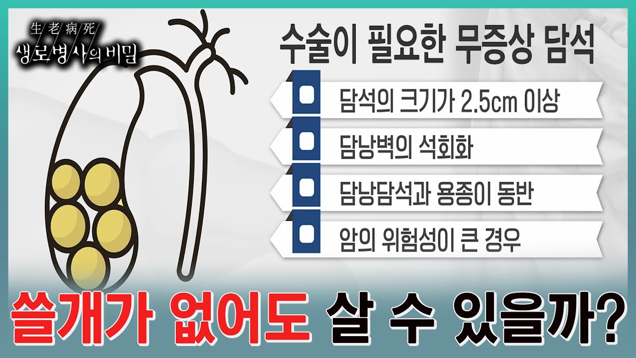 담낭의 돌만 제거할 수 없기에, 담낭(쓸개)를 전부 절제해야하는 담석증. 그렇다면 쓸개가 없어도 살아가는데 지장이 없을까? l KBS 20231018 방송