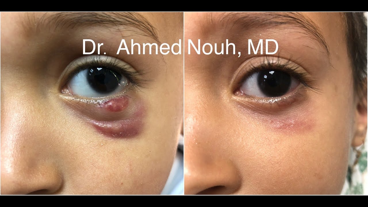 Juvenile Xanthogranuloma with Real case management