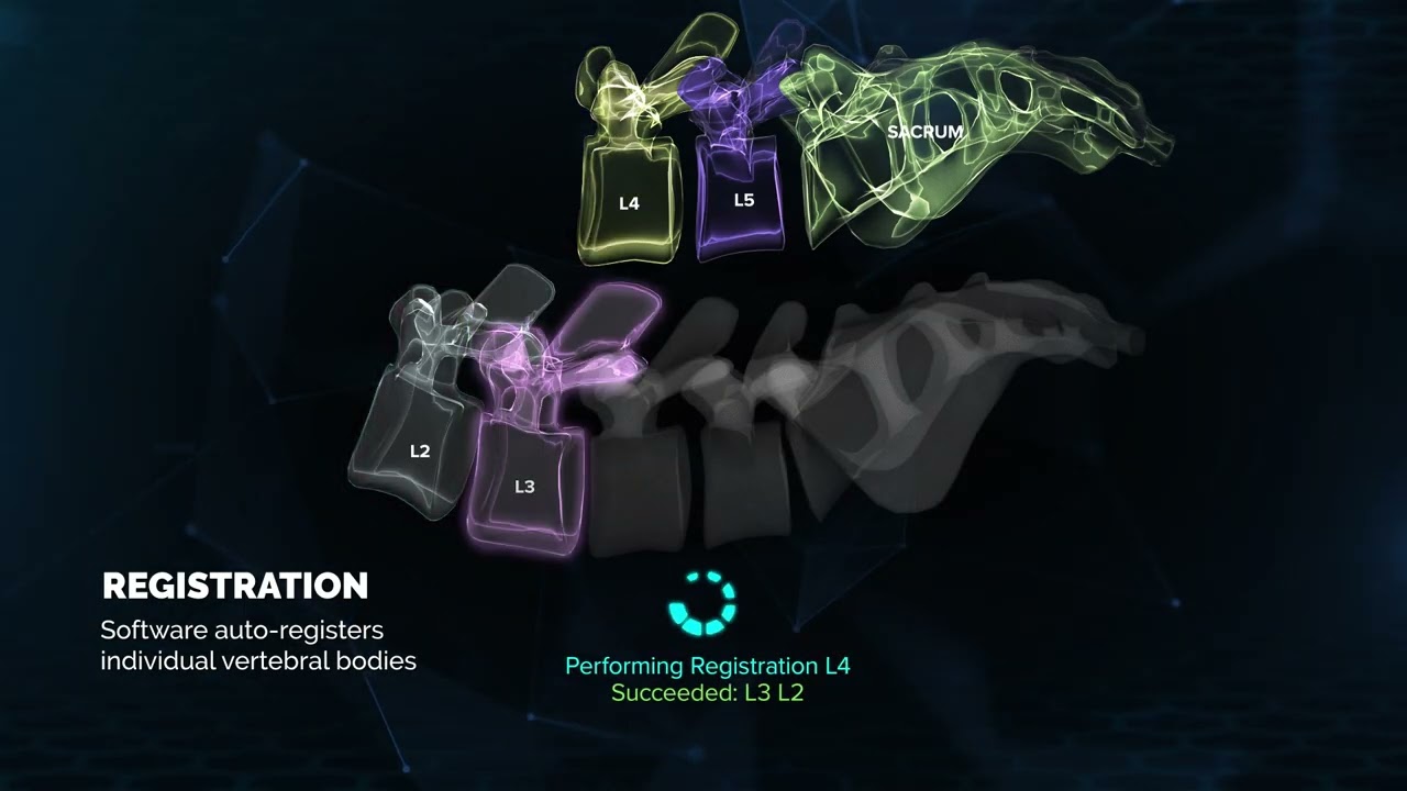 CT-Fluoro Registration: Here's how we combine AR + AI for efficient, effective navigation
